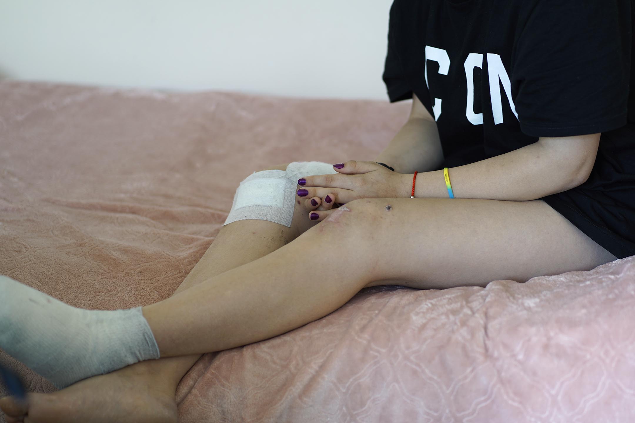 15歲的阿納斯塔西婭,她在東部的家鄉波帕斯納小鎮救人的過程中受傷,被撤到利沃夫治療。該鎮在她逃出不久後,已遭到俄軍佔領。